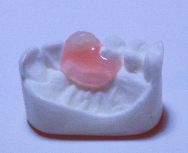 一本だけの部分入れ歯でも